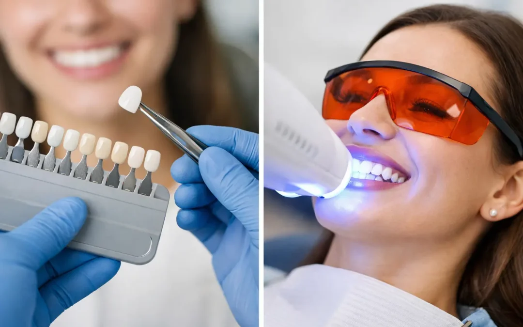 Carillas dentales o blanqueamiento: qué elegir