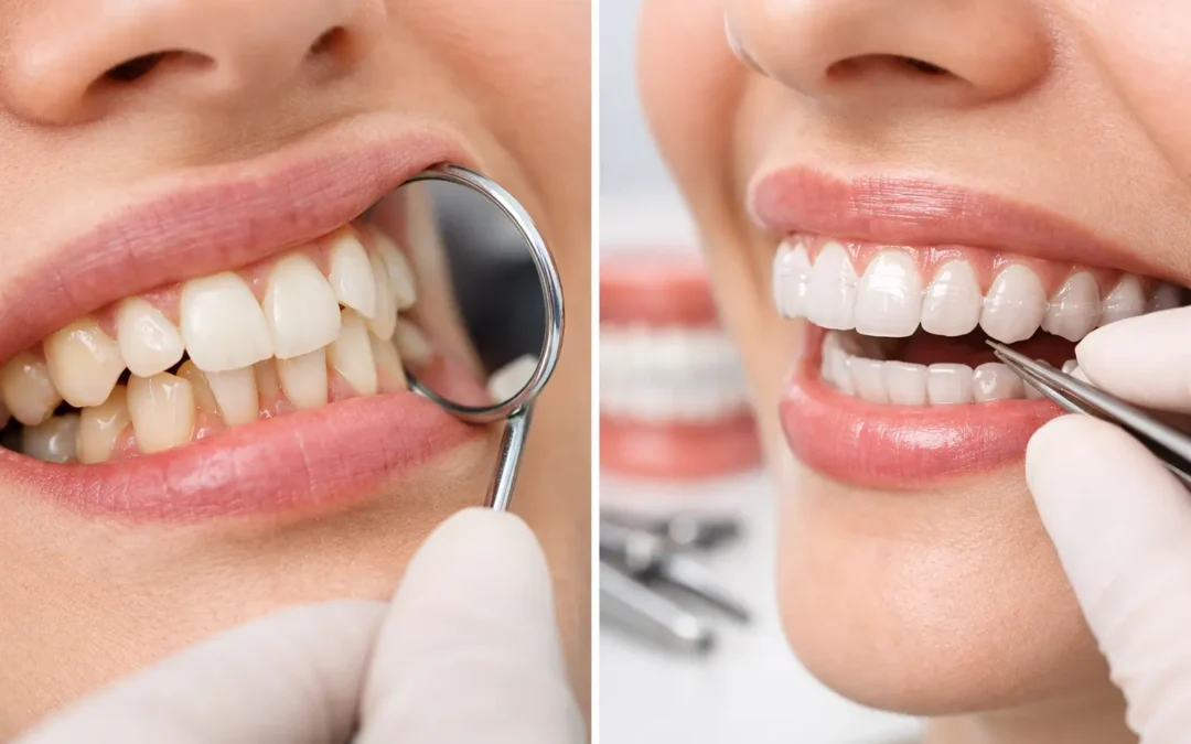 Cómo corregir dientes apiñados